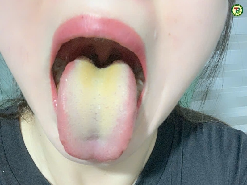 Bệnh nấm lưỡi trắng ở người lớn